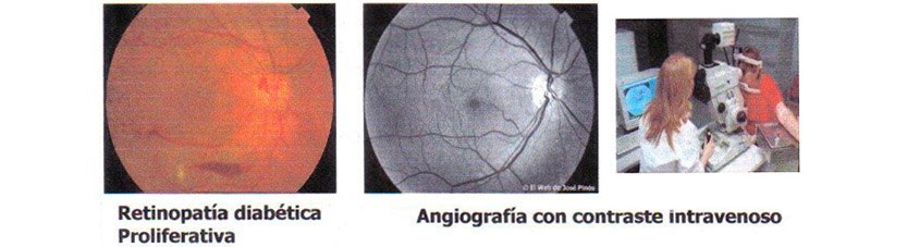 Centro Oftalmológico Carballiño retinopatía