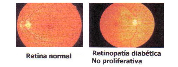 Centro Oftalmológico Carballiño retina