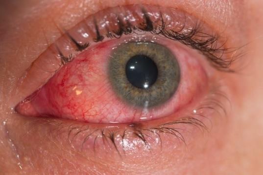 CONJUNTIVITIS