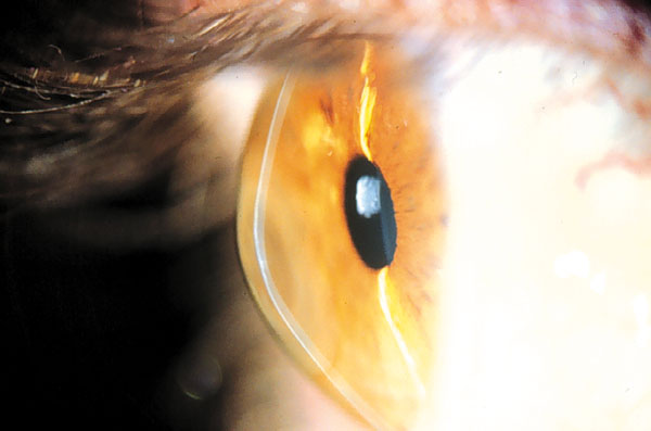 QUERATOCONO (CORNEA CONICA)