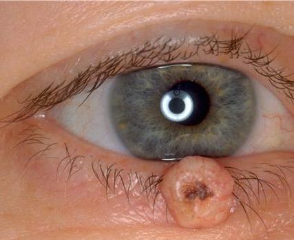 Human papilloma virus ocular