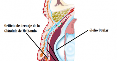 HIGIENE PALPEBRAL, SU IMPORTANCIA EN CASO DE DISFUNCIÓN DE LAS GLÁNDULAS DE MEIBOMIO