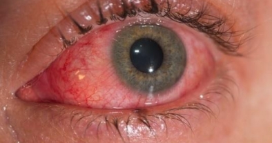 CONJUNTIVITIS