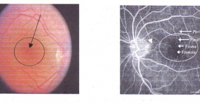 LA DEGENERACIÓN MACULAR (DMA)