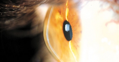 QUERATOCONO (CORNEA CONICA)